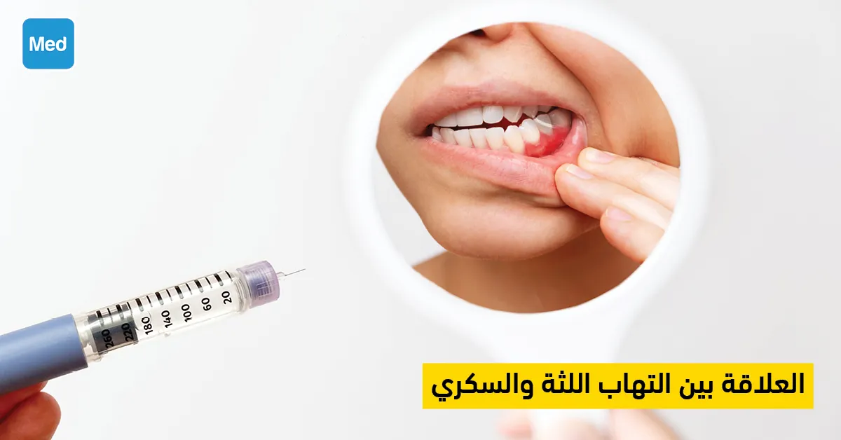 العلاقة بين التهاب اللثة والسكري